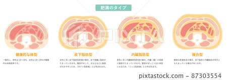 Obesity type 03 87303554