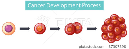 Process of cancer development infographic 87307898