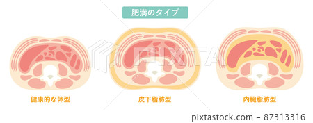 Obesity type 08 87313316