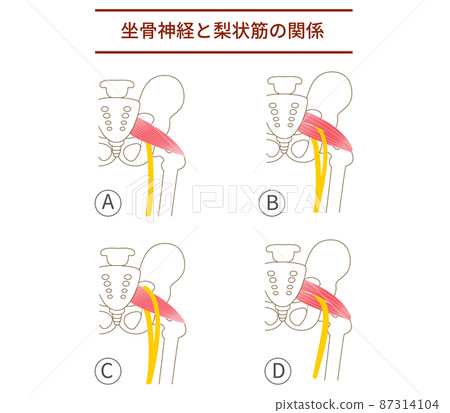 梨狀肌和坐骨神經圖解 87314104