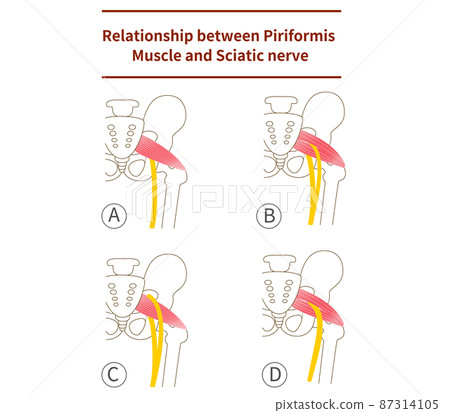 Illustration of piriformis and sciatic nerve 87314105