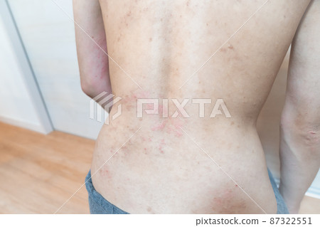 Image of atopy / heat rash / dermatitis. A photo of a man with rough skin. 87322551