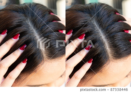 Woman Before and After dandruff Treatment. Problem health care concept. 87338446