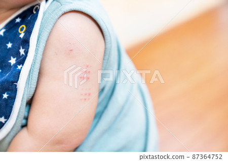 A photo of a baby's arm with a stamp injection. Image of child vaccination. 87364752