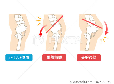 骨盆前傾和後傾 87402930
