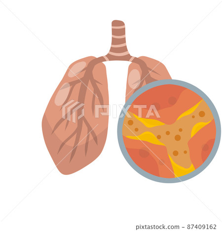 Lung disease. Blockage of canal. Mucus in alveoli. Breathing problems. 87409162