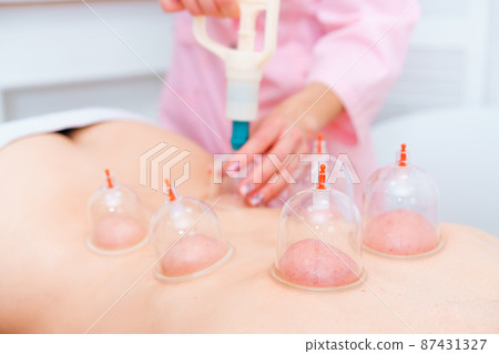 Acupuncture therapist places cup on back of female patient. Caucasian woman 87431327