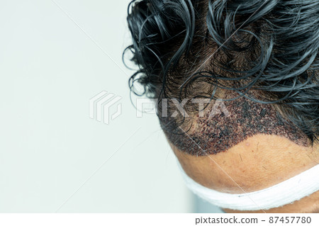 Man head with hair transplant surgery with receding hair line, FUE, Follicular unit extraction, Types of hair transplant procedures and their stages. Male alopecia treatment. 87457780
