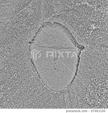 adenocarcinoma 87463194