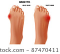 Artritic tailors bunion and hallux valgus foot bunion rheumatoid sore joints, top view. 87470411