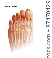 Mortons neuroma. Foot pain strain bottom view. Realistic anatomy illustration 87470429