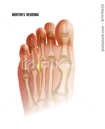 Mortons neuroma. Foot pain strain bottom view. Realistic anatomy illustration 87470429