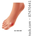 Arthritic hallux rigidus bunion rheumatoid sore joints, top view. 87470441