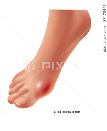 Arthritic hallux rigidus bunion rheumatoid sore joints, top view. 87470441