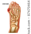 Artritic bunion rheumatoid sore joints, top view. 87470464