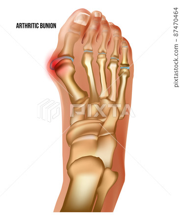 Artritic bunion rheumatoid sore joints, top view. 87470464