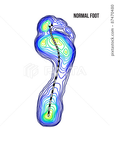 Foot weight distribution. Normal arch foot bottom thermal view. No deformation. 87470480