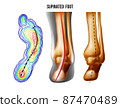Supinated foot, arch deformation, bottom and back view . Foot weight distribution. 87470489