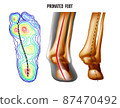 Pronated foot, arch deformation, bottom and back view . Foot weight distribution. 87470492