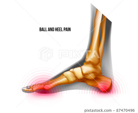 Ball and heel of foot pain bones skeleton realistic anatomy illustration 87470496