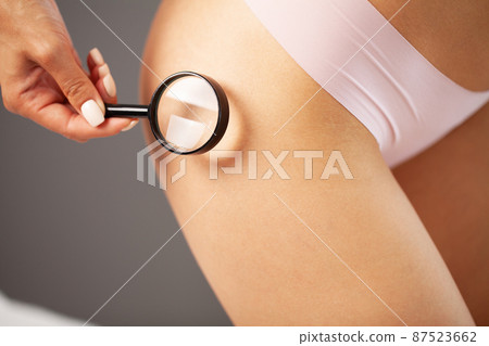 A woman who puts a loupe on her leg. A woman who puts a loupe on her leg. 87523662