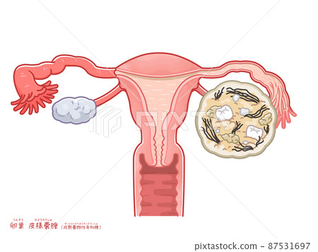 Illustration of ovarian cyst, cutaneous cyst, teratoma 87531697