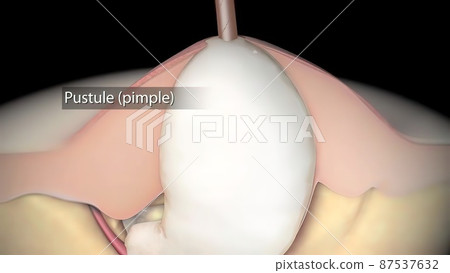 inflammatory acne occurs when bacteria infect clogged or closed pores 87537632