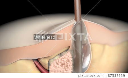 Acne or pimple formation.The sebum in the clogged pore encourages the growth of a certain bacteria 87537639