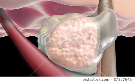 This leads to the redness and inflammation associated with pimples 87537646