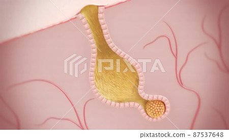 Acne And Pimples, Stages Of Development, Graphic illustration Acne And Pimples, Stages Of Development, Graphic illustration 87537648