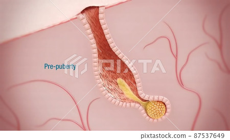 Acne And Pimples, Stages Of Development, Graphic illustration Acne And Pimples, Stages Of Development, Graphic illustration 87537649