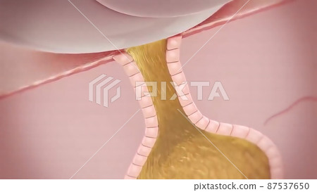 Acne And Pimples, Stages Of Development, Graphic illustration 87537650