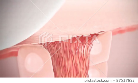 Acne or pimple formation.The sebum in the clogged pore encourages the growth of a certain bacteria Acne or pimple formation.The sebum in the clogged pore encourages the growth of a certain bacteria 87537652