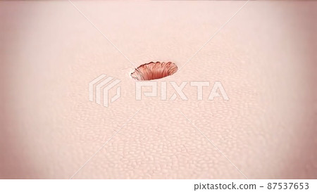 Acne And Pimples, Stages Of Development, 87537653