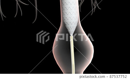 abdominal aortic aneurysm treatment abdominal aortic aneurysm treatment 87537752