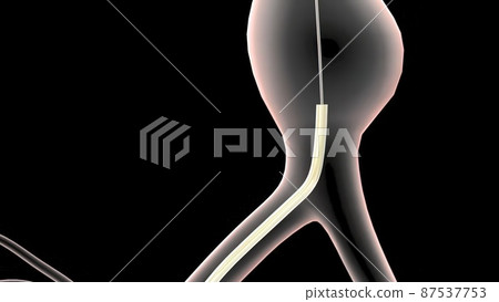 abdominal aortic aneurysm treatment abdominal aortic aneurysm treatment 87537753