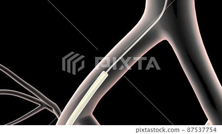 abdominal aortic aneurysm treatment abdominal aortic aneurysm treatment 87537754