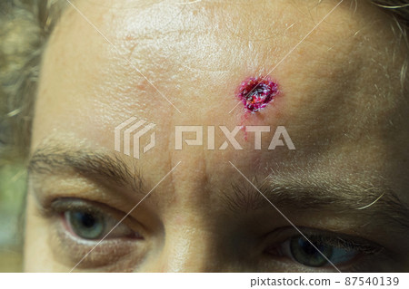 Close-up of a fresh wound after removal of a mole on a woman's forehead. Concept of nevus removal. Close-up of a fresh wound after removal of a mole on a woman's forehead. Concept of nevus removal. 87540139