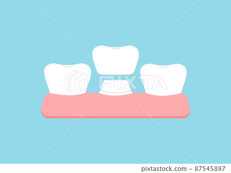 Tooth with crown in gum dental vector sign isolated. Tooth with crown in gum dental vector sign isolated. 87545897
