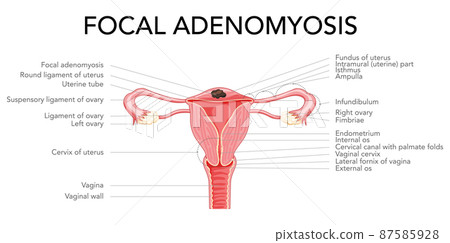 Focal Adenomyosis with inscriptions, Human anatomy Female reproductive Sick system organs. Structure of uterus, cervix 87585928