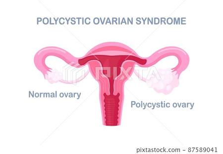Polycystic ovary syndrome. PCOS hormonal diagnose. Female reproductive system with ovary, uterus, fallopian tubes. Female organs disease Polycystic ovary syndrome. PCOS hormonal diagnose. Female reproductive system with ovary, uterus, fallopian tubes. Female organs disease 87589041