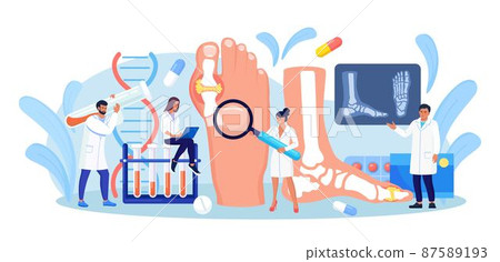 Gout treatment. Arthritis joint in the ankle. Doctor diagnoses swollen and inflamed foot joint. Physician looking at x-ray scan. Human feet bone with uric acid crystals. Medical appointment and exam 87589193