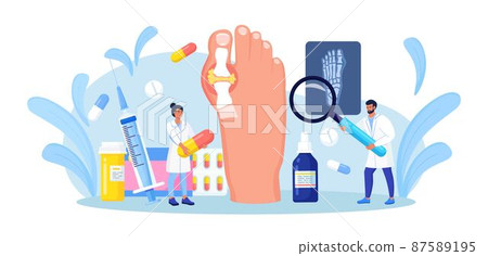 Gout treatment. Arthritis joint in the ankle. Doctor diagnoses swollen and inflamed foot joint. Physician looking at x-ray scan. Human feet bone with uric acid crystals. Medical appointment and exam Gout treatment. Arthritis joint in the ankle. Doctor diagnoses swollen and inflamed foot joint. Physician looking at x-ray scan. Human feet bone with uric acid crystals. Medical appointment and exam 87589195