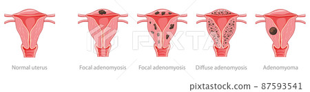Adenomyosis Focal, Diffuse, Adenomyoma and normal uterus Human anatomy Female reproductive Sick system, organs icon Adenomyosis Focal, Diffuse, Adenomyoma and normal uterus Human anatomy Female reproductive Sick system, organs icon 87593541