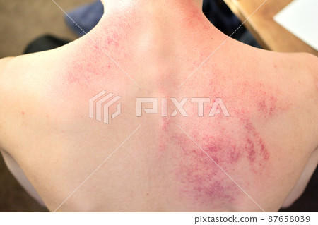 由於Cassa或濫用而在背部留下的皮下出血痕跡 87658039