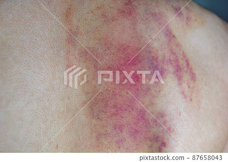 Subcutaneous bleeding marks left on the back due to Cassa or abuse 87658043