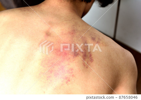 由於Cassa或濫用而在背部留下的皮下出血痕跡 由於Cassa或濫用而在背部留下的皮下出血痕跡 87658046