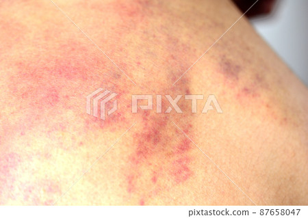 Subcutaneous bleeding marks left on the back due to Cassa or abuse Subcutaneous bleeding marks left on the back due to Cassa or abuse 87658047