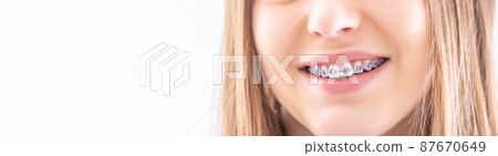 Dental brace on healthy teeth of a young teenage girl. 87670649