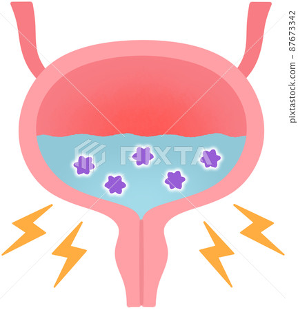 Inflamed bladder 87673342